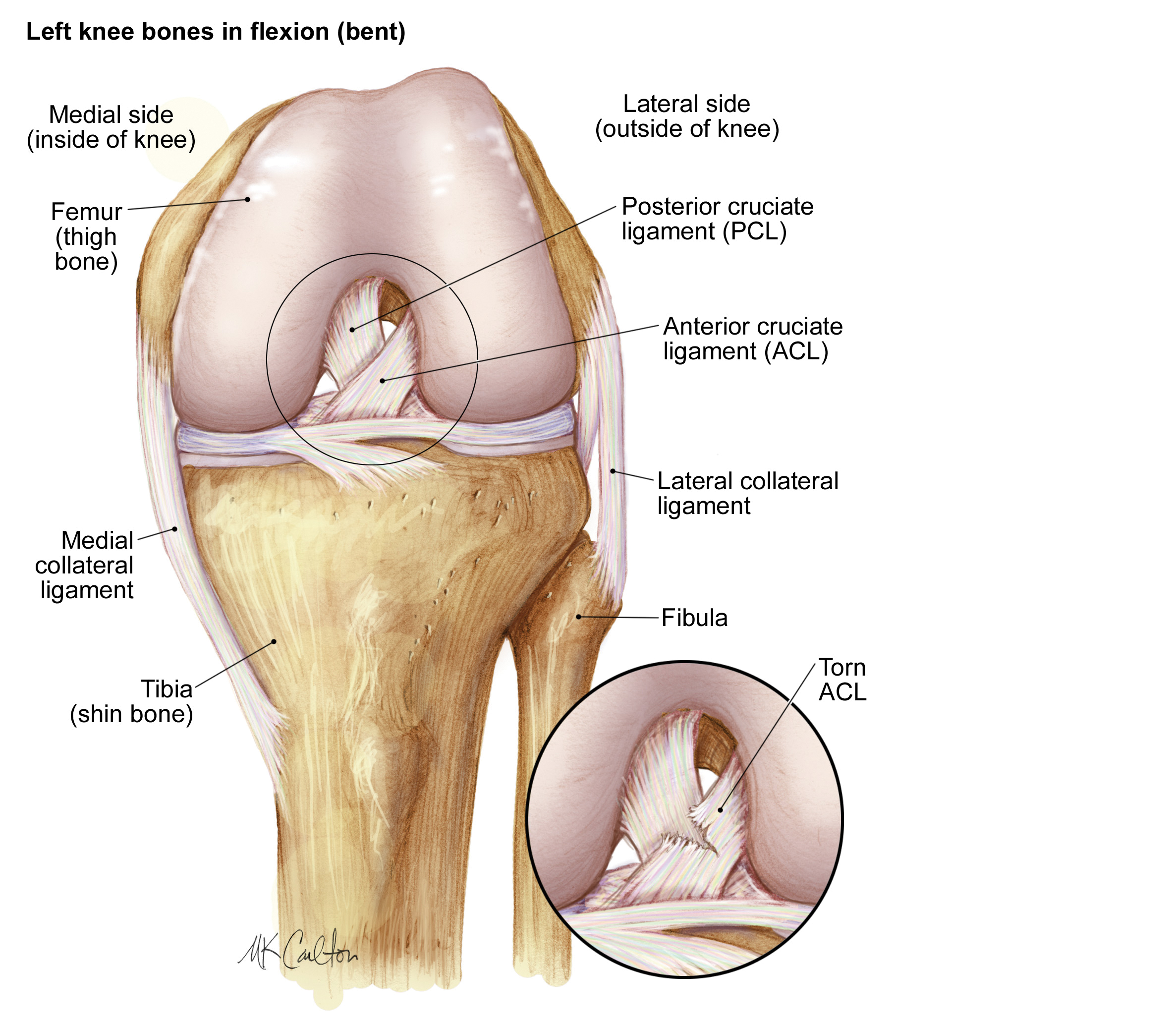 Acl Injuries How Do They Occur And What Are Treatment Options